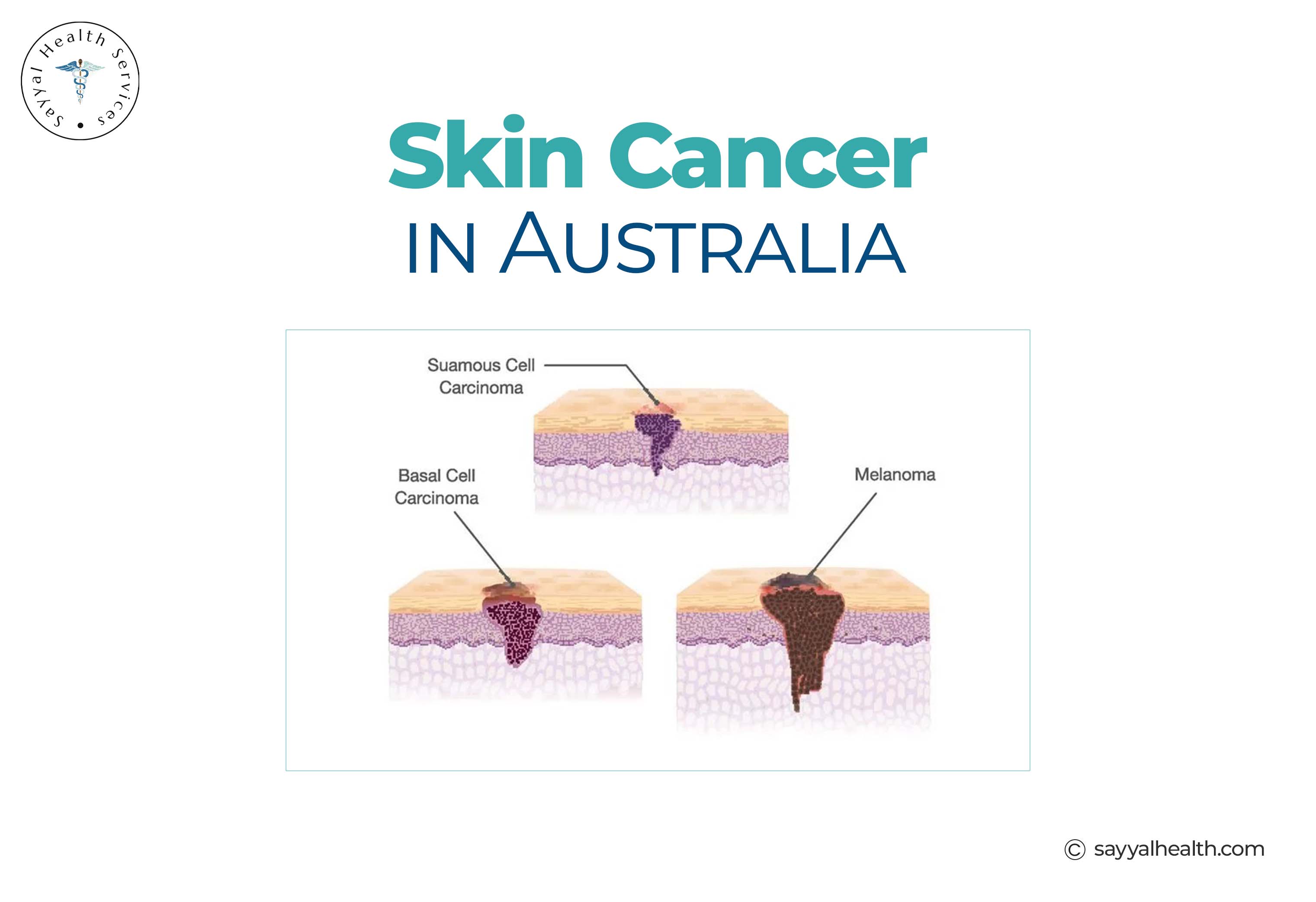 Types of Skin Cancer